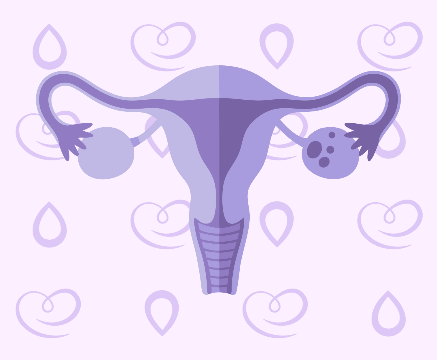 síndrome dos ovários policísticos